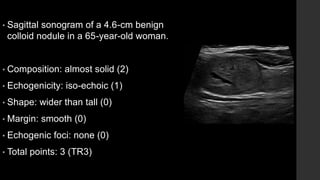 • Sagittal sonogram of a 4.6-cm benign
colloid nodule in a 65-year-old woman.
• Composition: almost solid (2)
• Echogenicity: iso-echoic (1)
• Shape: wider than tall (0)
• Margin: smooth (0)
• Echogenic foci: none (0)
• Total points: 3 (TR3)
 