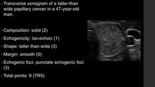 • Transverse sonogram of a taller-than
wide papillary cancer in a 47-year-old
man.
• Composition: solid (2)
• Echogenicity: iso-echoic (1)
• Shape: taller than wide (3)
• Margin: smooth (0)
• Echogenic foci: punctate echogenic foci
(3)
• Total points: 9 (TR5)
 