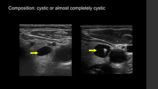 Composition: cystic or almost completely cystic
 