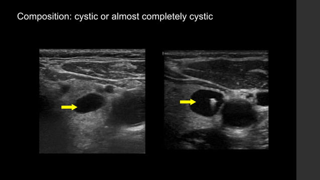 thyroid imaging reporting & data system | PPTX