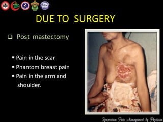 DUE TO SURGERY
 Post mastectomy
 Pain in the scar
 Phantom breast pain
 Pain in the arm and
shoulder.
 