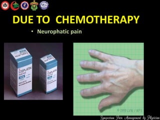 DUE TO CHEMOTHERAPY
• Neurophatic pain
 