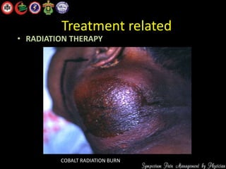 Treatment related
• RADIATION THERAPY
COBALT RADIATION BURN
 