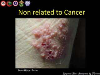 Non related to Cancer
Acute Herpes Zoster
 