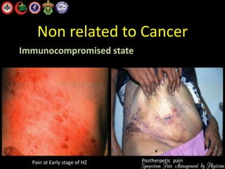 Non related to Cancer
Immunocompromised state
Pain at Early stage of HZ Postherpetic pain
 