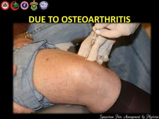 DUE TO OSTEOARTHRITIS
 