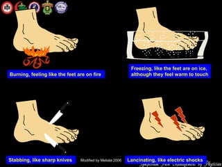 Burning, feeling like the feet are on fire
Stabbing, like sharp knives Lancinating, like electric shocks
Freezing, like the feet are on ice,
although they feel warm to touch
Modified by Meliala 2006
 