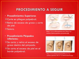 • Procedimientos Superiores
Corte en pliegue palpebral.
Retiro de exceso de grasa y corte
de piel.
Sutura.
• Procedimiento Párpados
inferiores:
Se corta y retira el exceso de
grasa dentro del párpado.
Se corta el exceso de piel en el
borde palpebral.
http://www.colaboracioncientifica.es/wp-
content/uploads/2015/12/blefaroplastia.jpg
https://www.clinicaplanas.com/blog/wp-
content/blefaroplastia-parpados.jpg
 