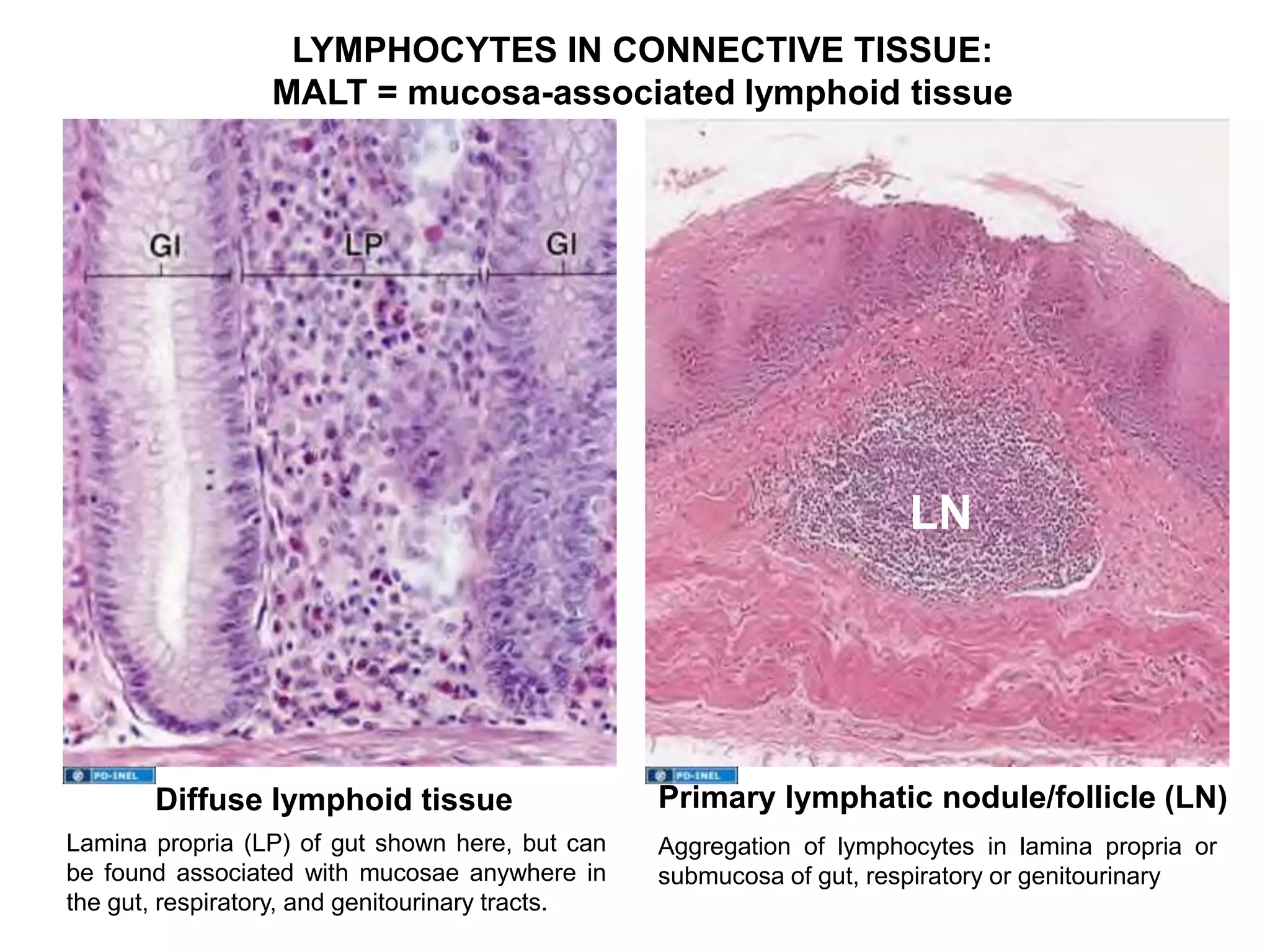 LN
LYMPHOCYTES IN CONNECTIVE TISSUE:
MALT = mucosa-associated lymphoid tissue
Primary lymphatic nodule/follicle (LN)Diffuse lymphoid tissue
Lamina propria (LP) of gut shown here, but can
be found associated with mucosae anywhere in
the gut, respiratory, and genitourinary tracts.
Aggregation of lymphocytes in lamina propria or
submucosa of gut, respiratory or genitourinary
 