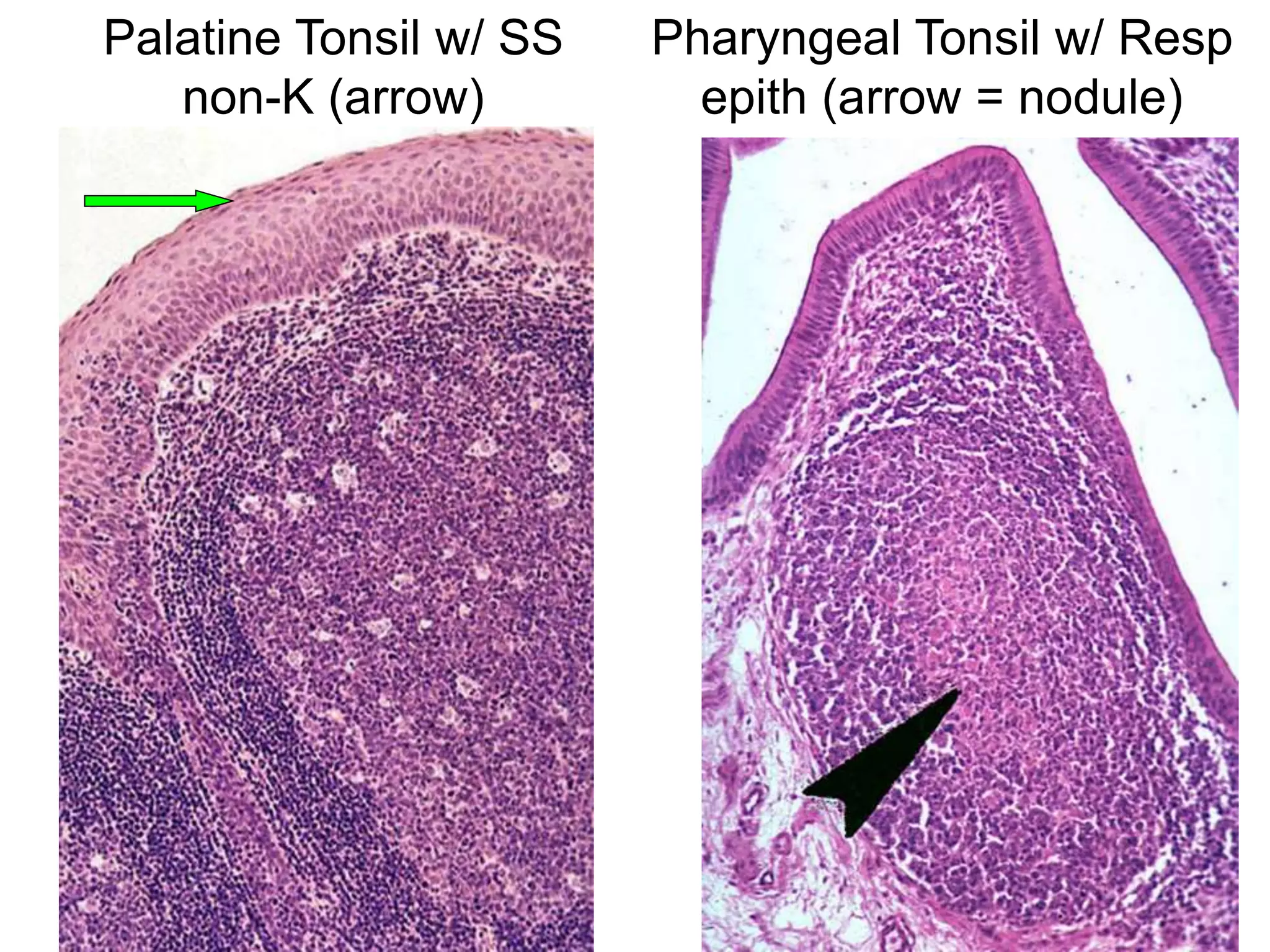 Palatine Tonsil w/ SS
non-K (arrow)
Pharyngeal Tonsil w/ Resp
epith (arrow = nodule)
 