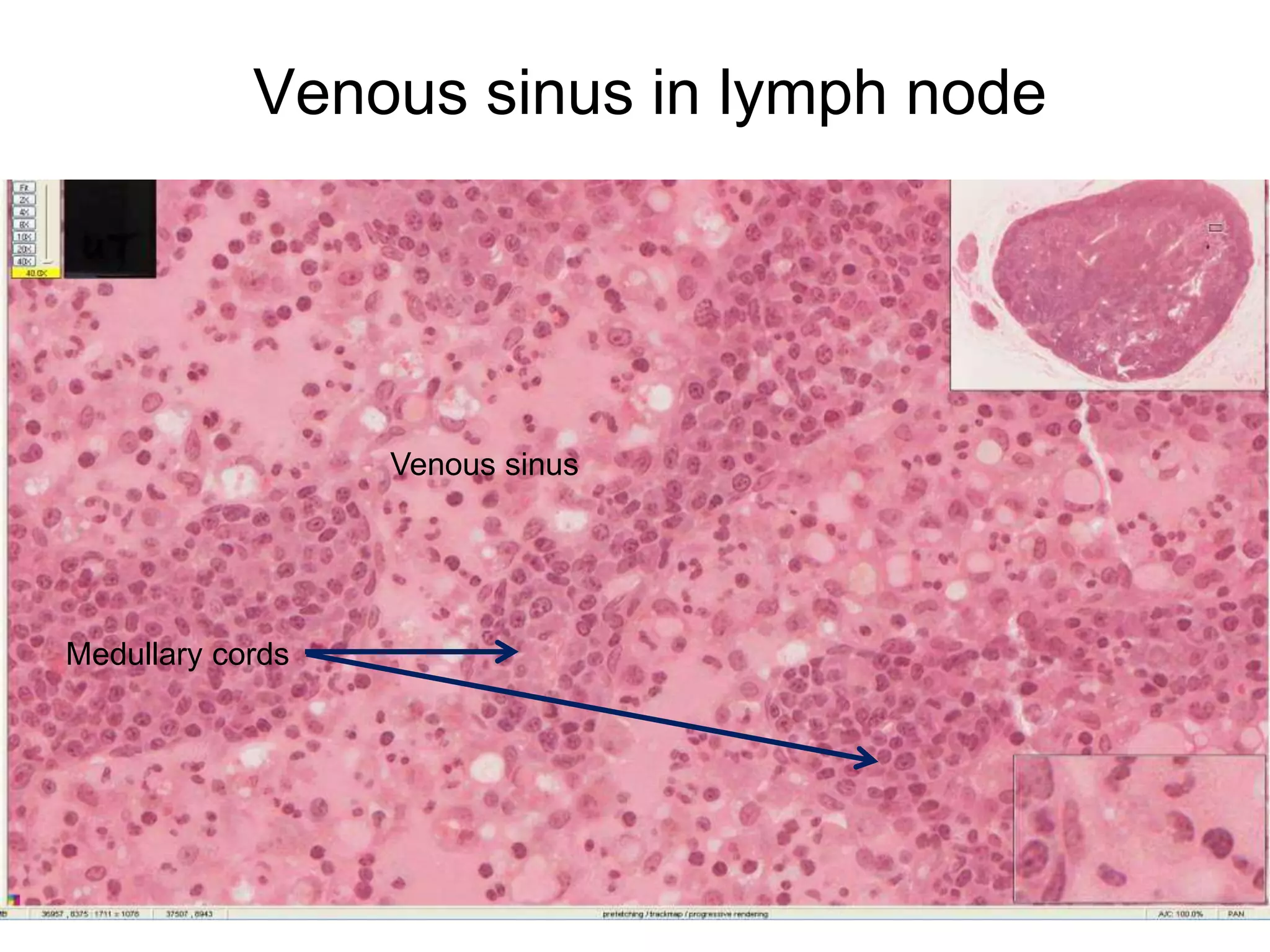 Venous sinus in lymph node
Medullary cords
Venous sinus
 