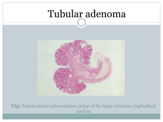 Fig: Pedunculated adenomatous polyp of the large intestine, lngitudinal
section
Tubular adenoma
 