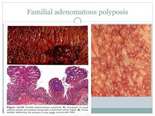 Familial adenomatous polyposis
 