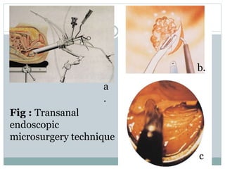 Fig : Transanal
endoscopic
microsurgery technique
a
.
c
b.
 