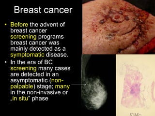 Breast cancer Before  the advent of breast cancer  screening  programs breast cancer was mainly detected as a  symptomatic  disease. In the era of BC  screening  many cases are detected in an asymptomatic ( non-palpable ) stage;  many  in the non-invasive or „ in situ ” phase 