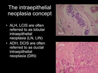 The intraepithelial neoplasia concept ALH, LCIS are often referred to as lobular intraepithelial neoplasia (LN, LIN) ADH, DCIS are often referred to as ductal intraepithelial neoplasia (DIN) ALH LCIS 