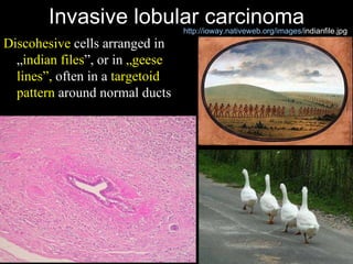 Invasive lobular carcinoma Discohesive  cells arranged in „ indian files ”, or in  „g ee se lines”,  often in a  targetoid pattern  around normal ducts http:// ioway.nativeweb.org / images / indianfile.jpg   