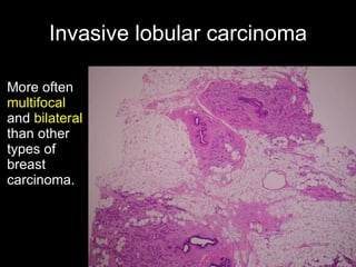 Invasive lobular carcinoma More often  multifocal  and  bilateral  than other types of breast carcinoma. 