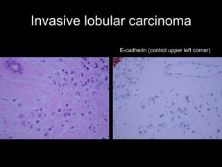 Invasive lobular carcinoma E-cadherin (control upper left corner) 
