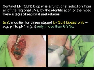Sentinel LN  (SLN)  biopsy  i s a functional selection from  all of the regional  LNs, by the identification of the most likely site (s)  of regional metastases (sn) : modifier for cases staged  by SLN biopsy only  – e.g. pT1c pN1mi(sn)  only if less than 6 SNs . 