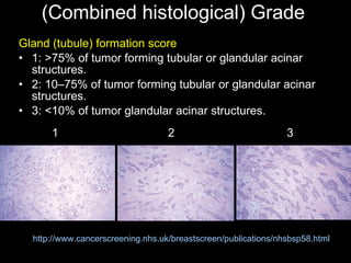 (Combined histological) Grade Gland (tubule) formation   score 1 :  >75% of tumor forming tubular or glandular acinar structures. 2 :  10–75% of tumor forming tubular or glandular acinar structures. 3 :  <10% of tumor glandular acinar structures. http://www.cancerscreening.nhs.uk/breastscreen/publications/nhsbsp58.html 1 2 3 