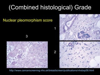 (Combined histological) Grade Nuclear pleomorphism  score http://www.cancerscreening.nhs.uk/breastscreen/publications/nhsbsp58.html 1 2 3 