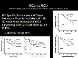 BC Specific Survival (A) and Distant Metastasis Free Survival (B) in G1, G2 G3 carcinomas (below) and in G2  carcinomas with  10% MIB index  cut-off  (right). G2a vs G2b Aleskandarany MA, et al. Breast Cancer Res Treat 2010 EPub AOP (Median MIB1 LI was 15%) 