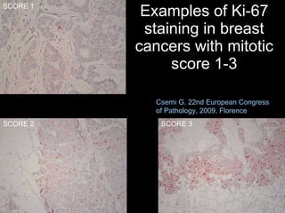Examples of Ki-67 staining in breast cancers with mitotic score 1-3 SCORE 2 SCORE 3 SCORE 1 Cserni G. 22nd European Congress  of Pathology, 2009, Florence 