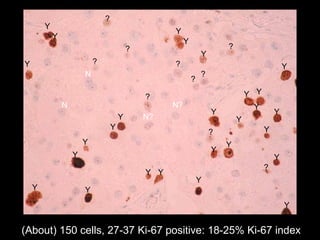 (About) 150 cells, 27-37 Ki-67 positive: 18-25% Ki-67 index Y Y Y Y Y Y Y Y ? ? ? ? Y Y Y Y Y Y Y Y Y Y Y Y Y Y Y Y Y Y Y ? ? ? ? ? N N ? N? N? 