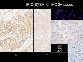 3+ 2+ (F-C-S)ISH for IHC 2+ cases FISH CISH SISH 