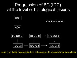 Progression of BC (IDC)  at the level of histological lesions UDH ADH LG DCIS IG DCIS HG DCIS IDC GI IDC GII IDC GIII Outdated model Usual type ductal hyperplasia does not proges s  into atypical ductal hyperplasia. 