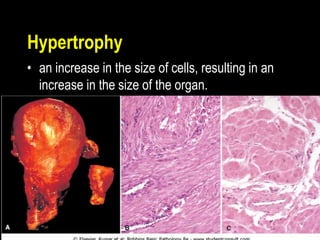 Hypertrophy
• an increase in the size of cells, resulting in an
increase in the size of the organ.
 