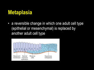 Metaplasia
• a reversible change in which one adult cell type
(epithelial or mesenchymal) is replaced by
another adult cell type
 