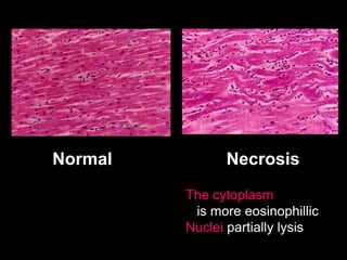 Normal Necrosis
The cytoplasm
is more eosinophillic
Nuclei partially lysis
 