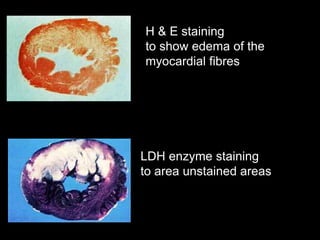 H & E staining
to show edema of the
myocardial fibres
LDH enzyme staining
to area unstained areas
 
