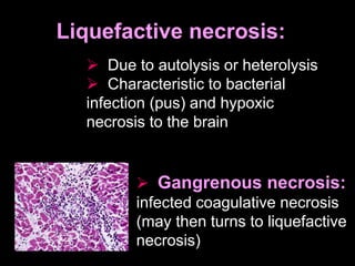 Liquefactive necrosis:
 Due to autolysis or heterolysis
 Characteristic to bacterial
infection (pus) and hypoxic
necrosis to the brain
 Gangrenous necrosis:
infected coagulative necrosis
(may then turns to liquefactive
necrosis)
 