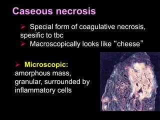 Caseous necrosis
 Special form of coagulative necrosis,
spesific to tbc
 Macroscopically looks like “cheese”
 Microscopic:
amorphous mass,
granular, surrounded by
inflammatory cells
 