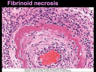 Fibrinoid necrosis
 
