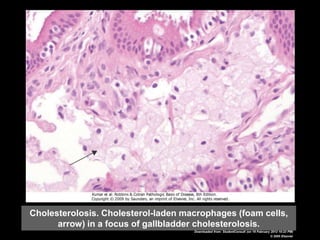 Cholesterolosis. Cholesterol-laden macrophages (foam cells,
arrow) in a focus of gallbladder cholesterolosis.
Downloaded from: StudentConsult (on 19 February 2012 10:23 PM)
© 2005 Elsevier
 