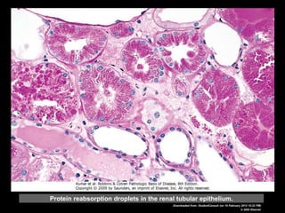Protein reabsorption droplets in the renal tubular epithelium.
Downloaded from: StudentConsult (on 19 February 2012 10:23 PM)
© 2005 Elsevier
 