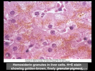Hemosiderin granules in liver cells. H+E stain
showing golden-brown, finely granular pigment.Downloaded from: StudentConsult (on 19 February 2012 10:23 PM)
© 2005 Elsevier
 