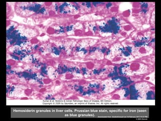 Hemosiderin granules in liver cells. Prussian blue stain, specific for iron (seen
as blue granules). Downloaded from: StudentConsult (on 19 February 2012 10:23 PM)
© 2005 Elsevier
 
