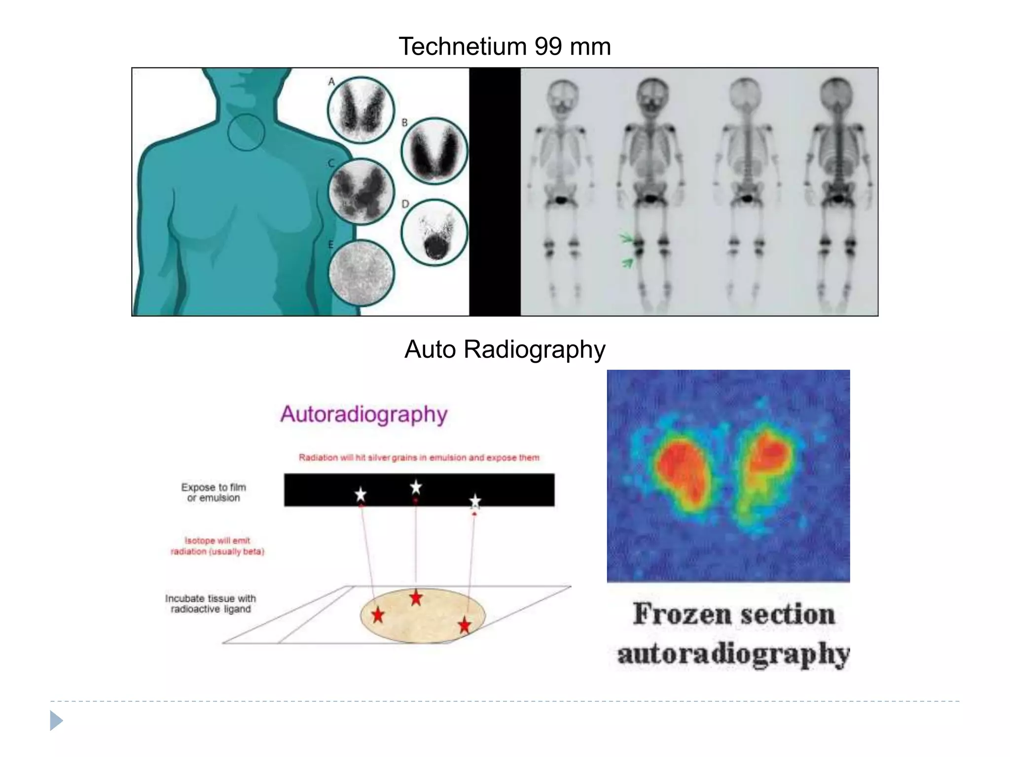 Technetium 99 mm
Auto Radiography
 
