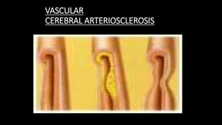 VASCULAR
CEREBRAL ARTERIOSCLEROSIS
 