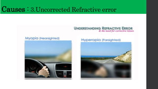 Computer Vision Syndrome | PPTX