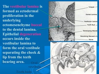 The vestibular lamina is 
formed as ectodermal 
proliferation in the 
underlying 
ectomesenchyme buccal 
to the dental lamina. 
Epithelial degeneration 
occurs inside the 
vestibular lamina to 
form the oral vestibule 
separating the cheek & 
lip from the teeth 
bearing area. Oral 
vestibule 
Teeth buds 
 