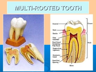 MMUULLTTII--RROOOOTTEEDD TTOOOOTTHH 
 