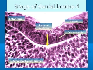 SSttaaggee ooff ddeennttaall llaammiinnaa--11 
Flat cells 
Columnar cells 
At 6-7 W.I.U.L 
Ectoderm 
Basement 
membrane 
Ectomesenchymal tissue 
 