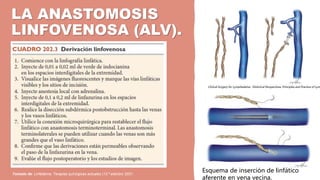 LA ANASTOMOSIS
LINFOVENOSA (ALV).
Tomado de: Linfedema, Terapias quirúrgicas actuales (13.ª edición) 2021.
Clinical Surgery for Lymphedema : Historical Perspectives, Principles and Practice of Lym
Esquema de inserción de linfático
aferente en vena vecina.
 