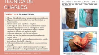 TECNICA DE
CHARLES.
Tomado de: Linfedema, Terapias quirúrgicas actuales (13.ª edición) 2021.
Sá, A., Pinheiro, C., Seixas-Martins, J., & Cunha, L.. (2015). La
técnica de Charles en el tratamiento del linfedema secundario crónico
del dorso del pie: caso clínico. Cirugía Plástica Ibero-
Latinoamericana.
 